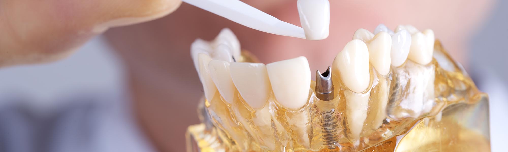 Dental Implants Dentists Carson CA