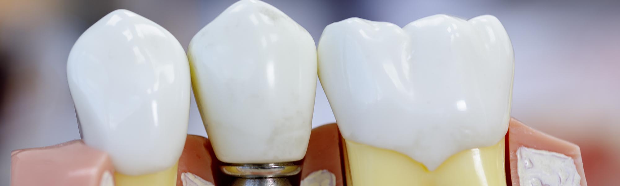 Multiple Teeth Implants Dentistry Carson CA