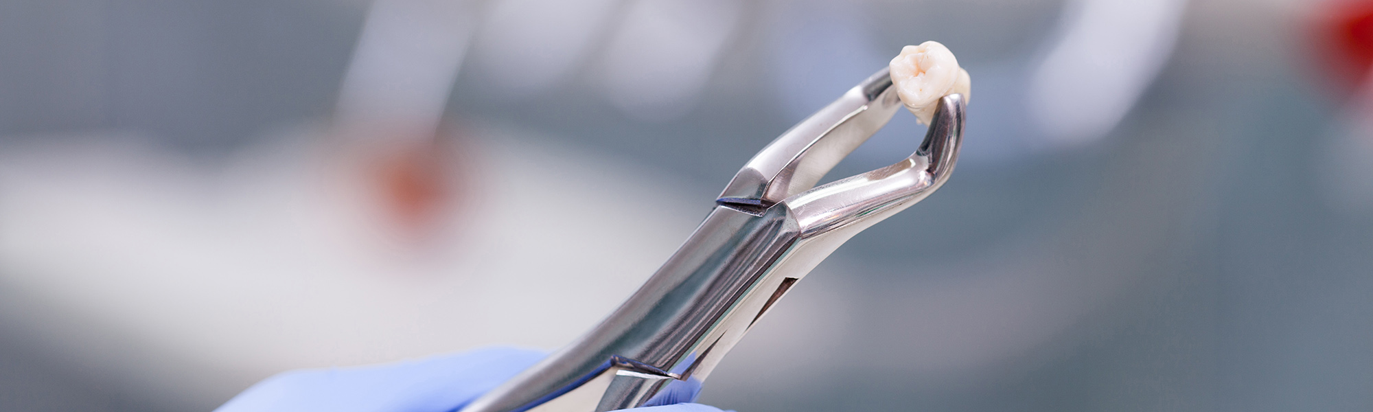 Wisdom Teeth: What You Need to Know for a Healthy Smile in Carson, CA