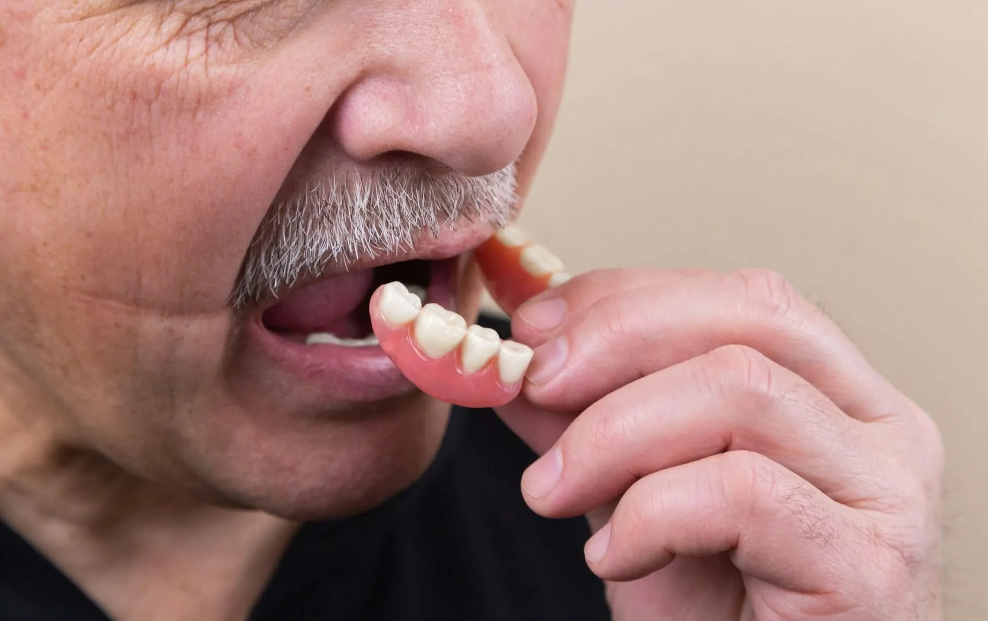 Benefits of All-on-4 Implants for Full-Arch Tooth Replacement
