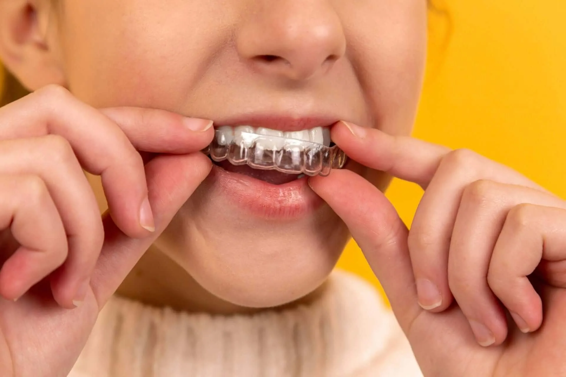Teen wearing clear aligners, highlighting the differences between Invisalign vs braces for teens