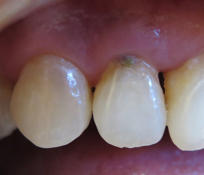 Composite Fillings Before