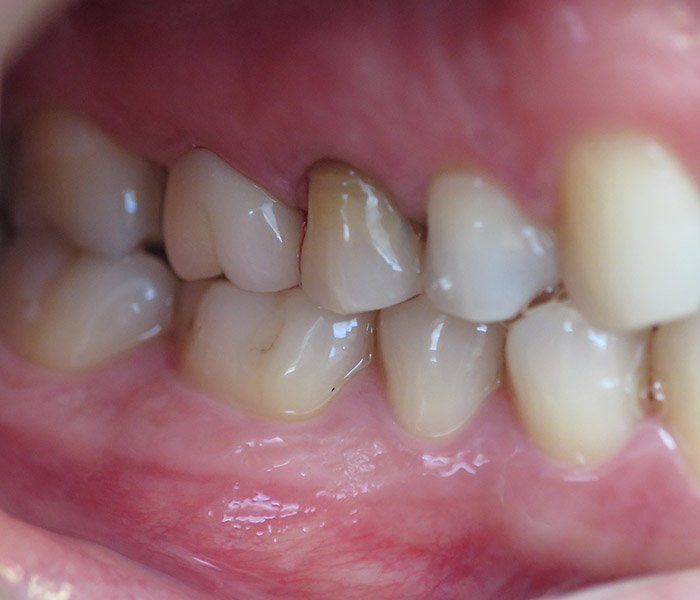 Dental Crowns After