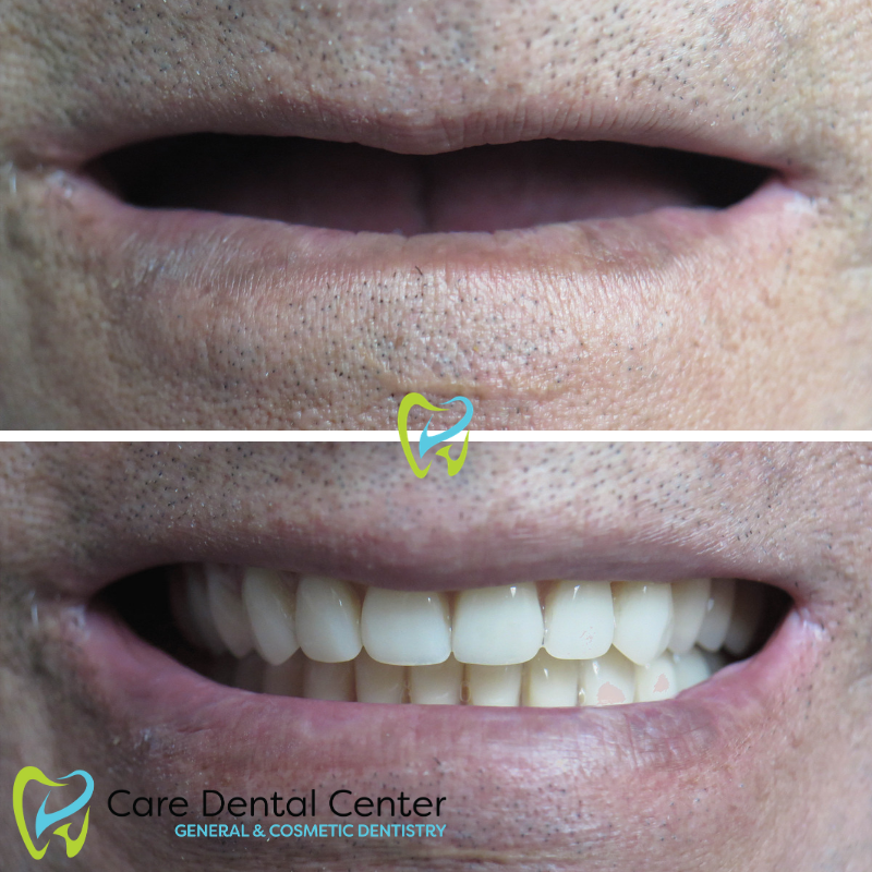 All on 4 Dental Implants