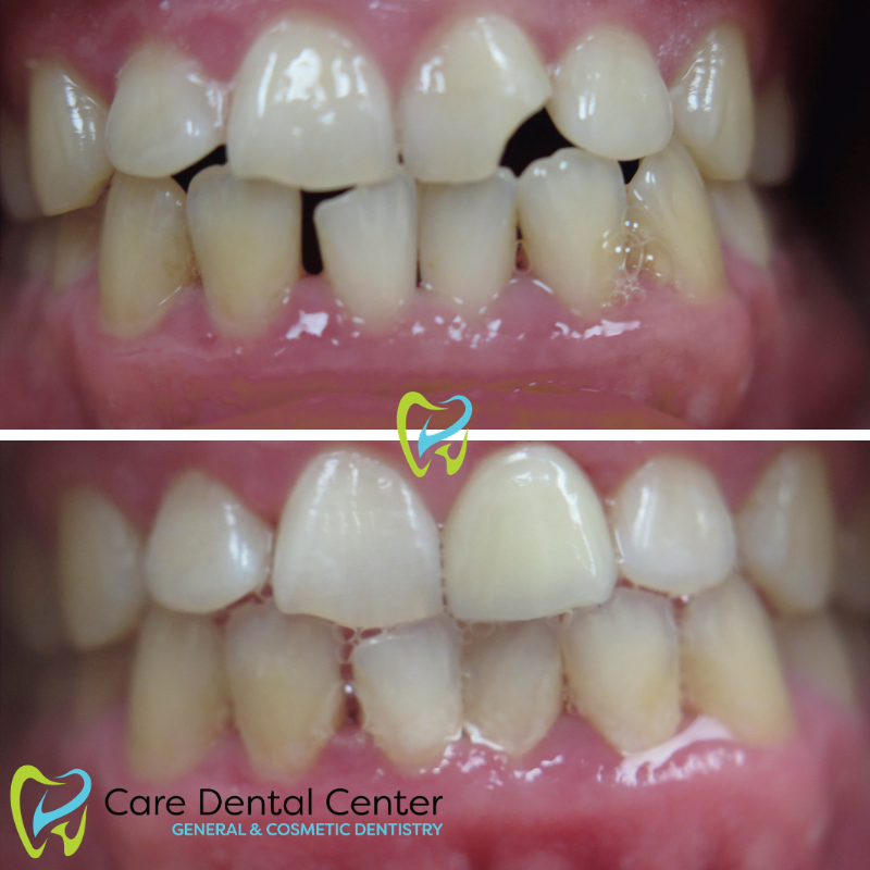 Dental Bonding Porcelain Veneers