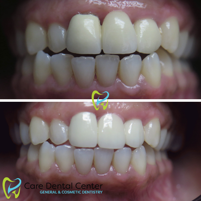 Dental Crown