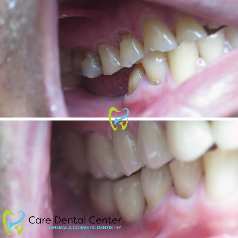 Dental Implant and Veneer