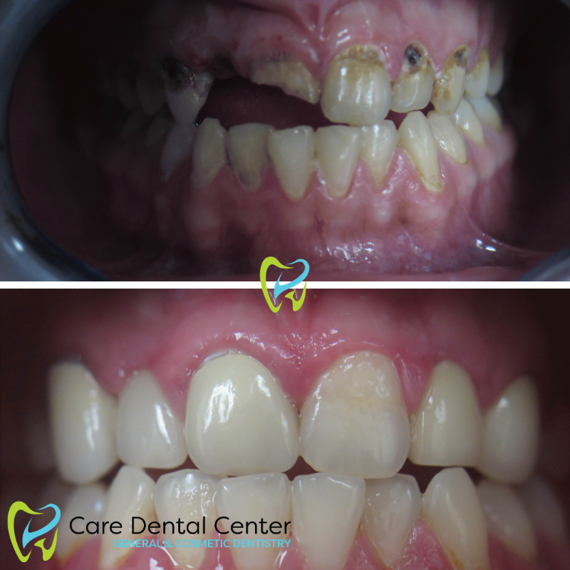 Dental Implants, Veneers, and Crown