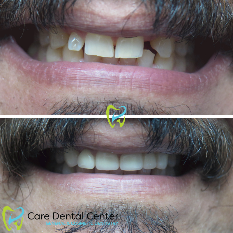 Dental Crown