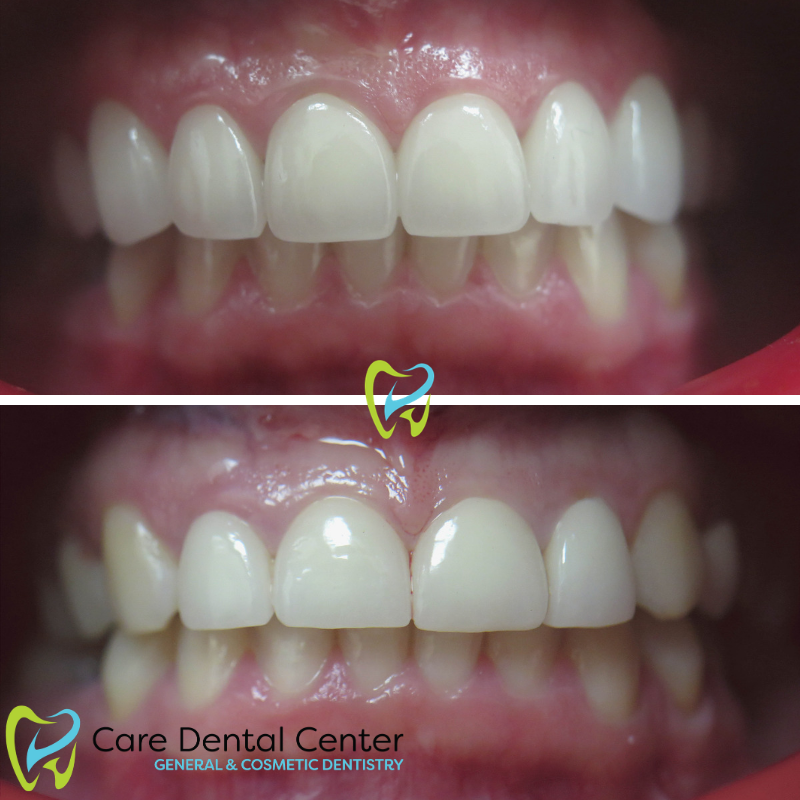 Porcelain Veneers