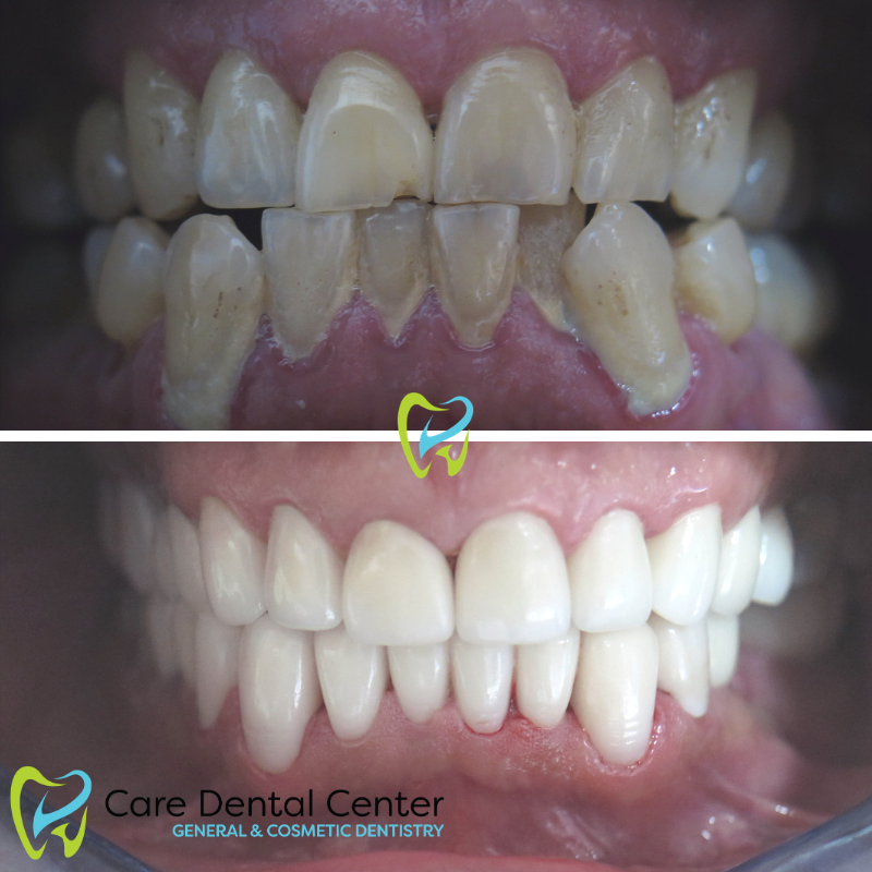 Porcelain Veneers
