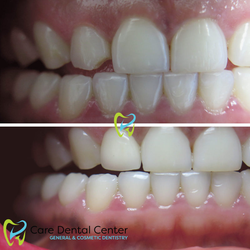 Porcelain Veneer