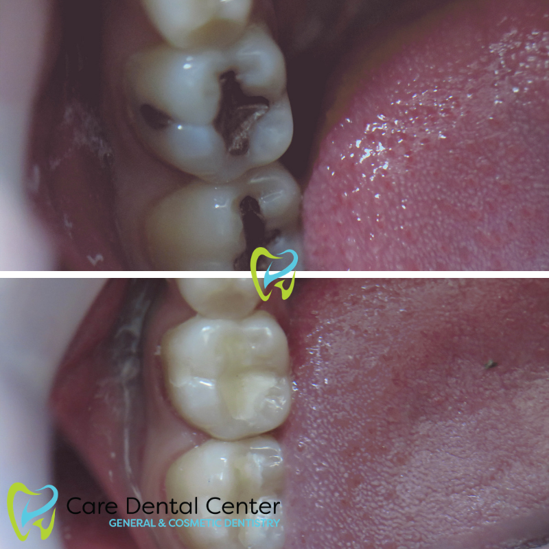 Dental Fillings