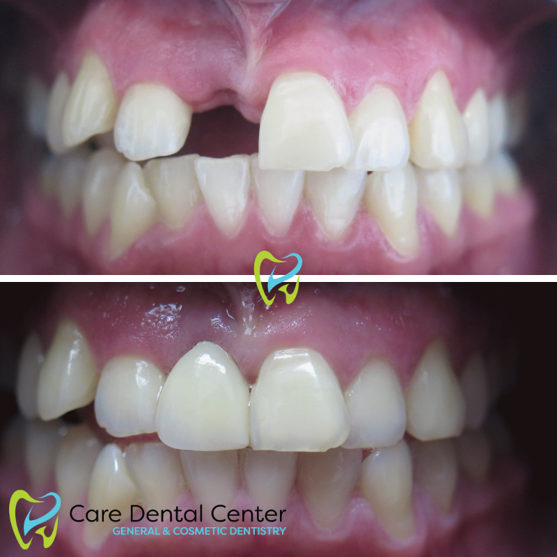 Dental Implants