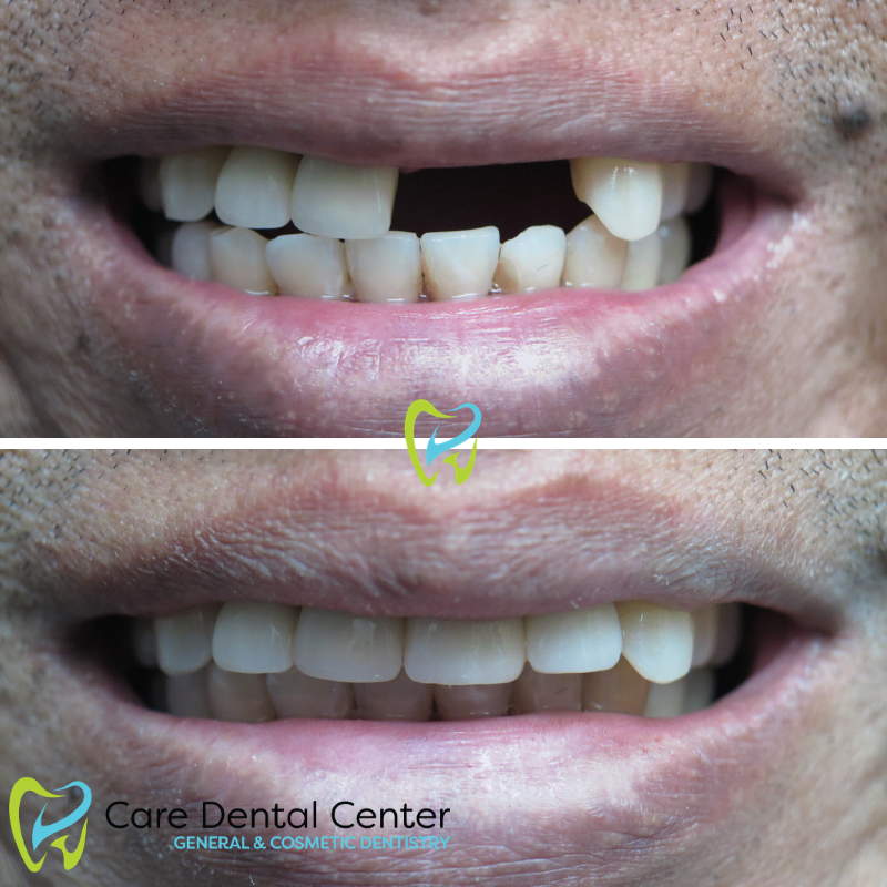 Dental Implants