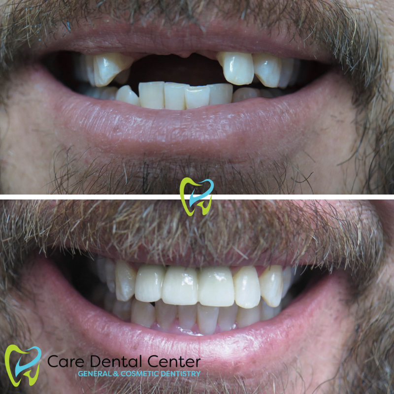 dental implants