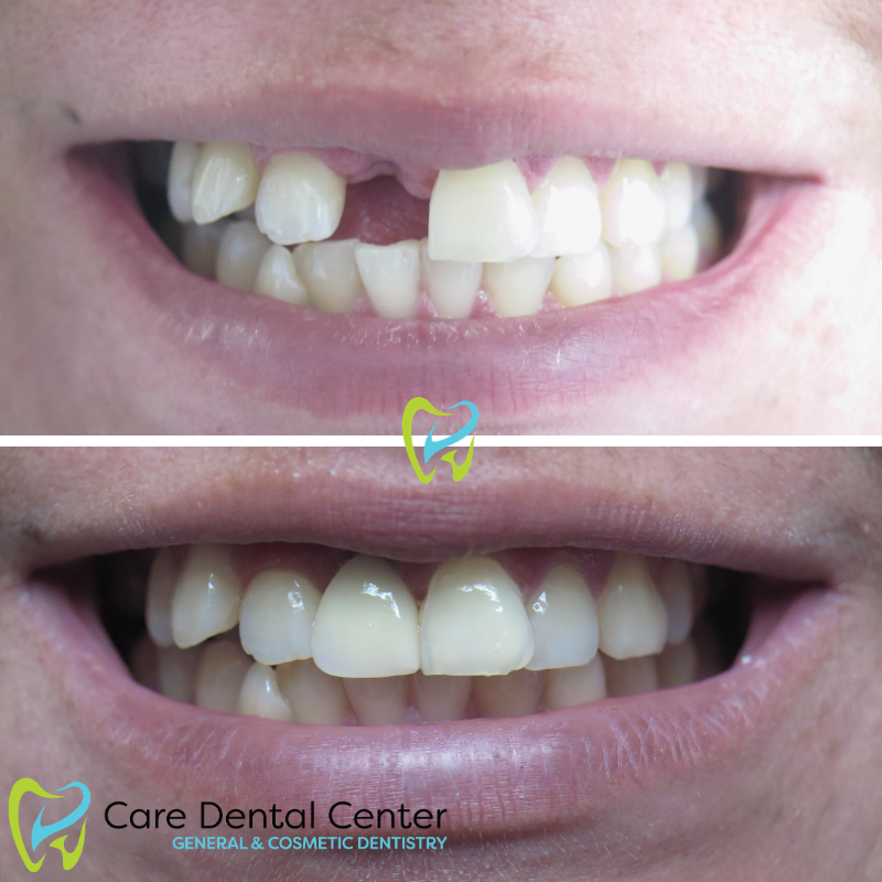 Dental Implant