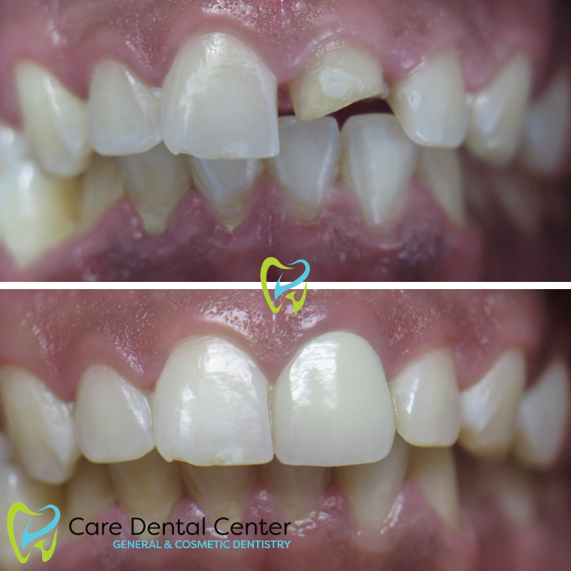 Dental Crown