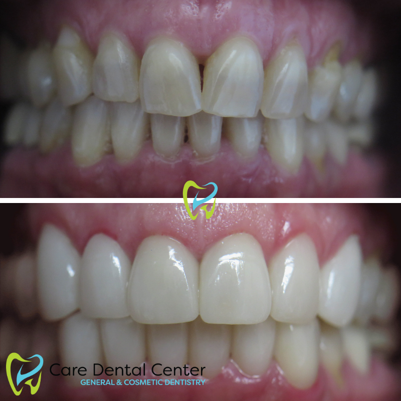 Porcelain Veneers