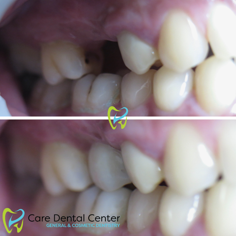 Dental Implant