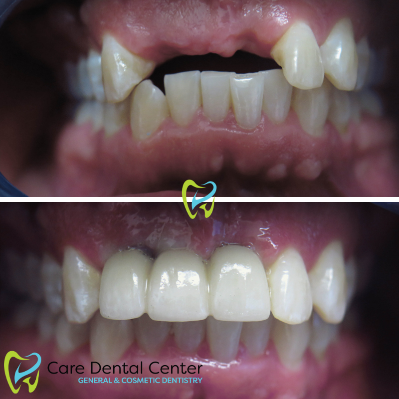 Dental Implants