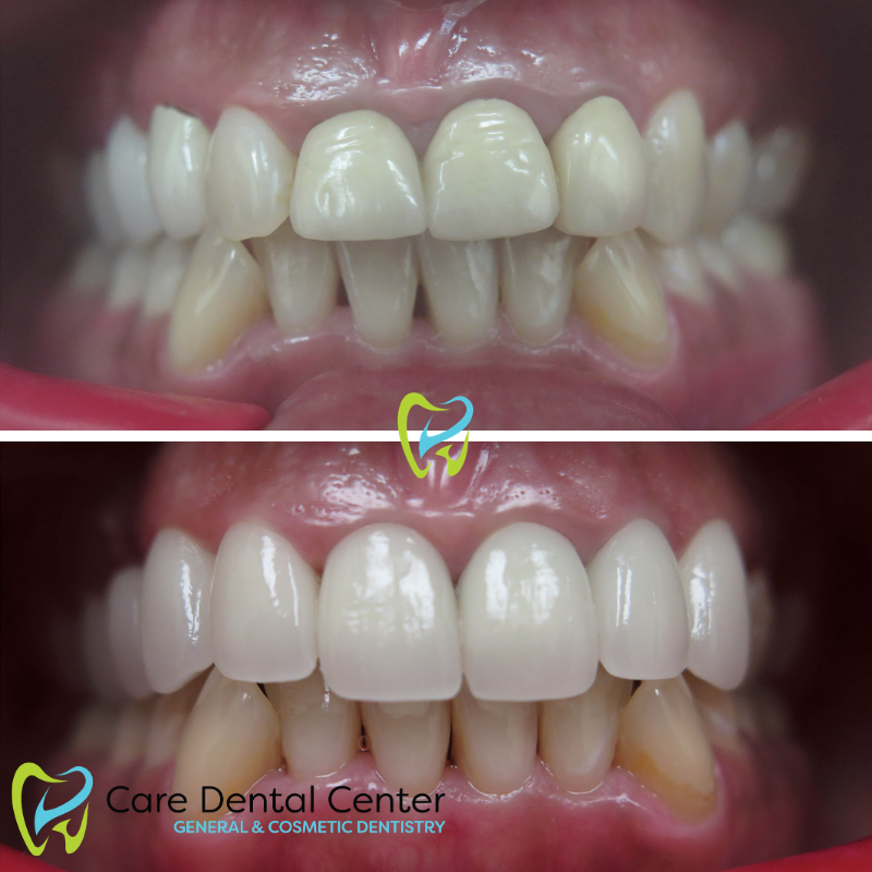 Porcelain Veneers