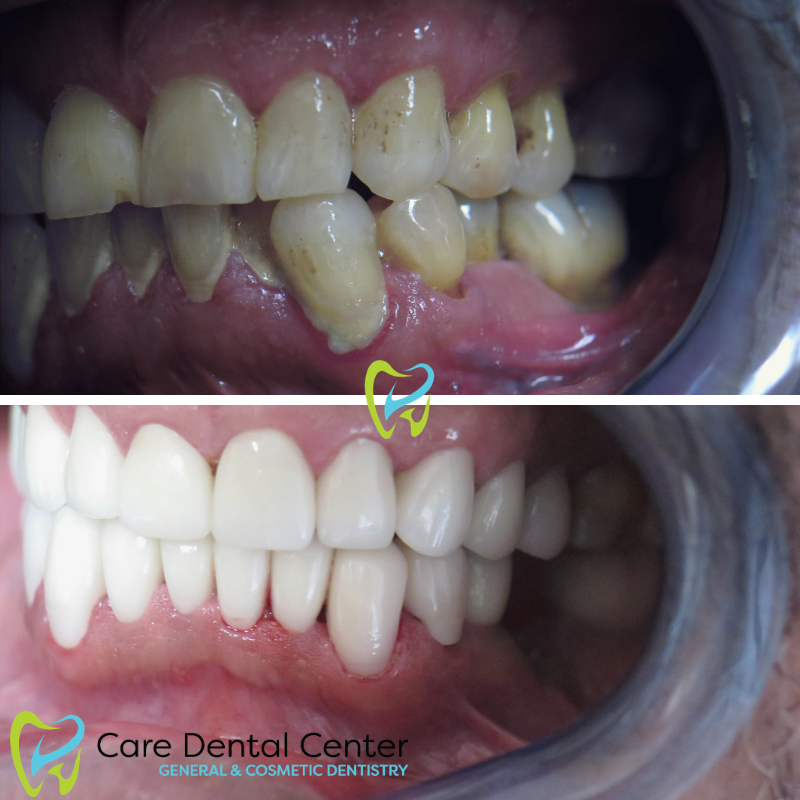 Porcelain Veneers