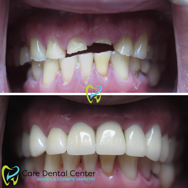Dental Implants and Veneers