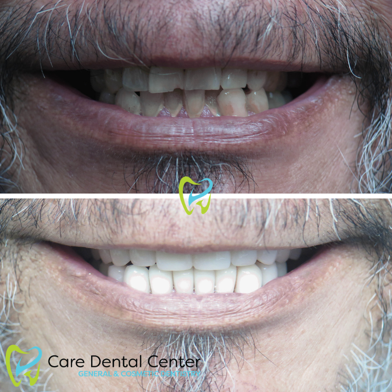 Porcelain Veneers
